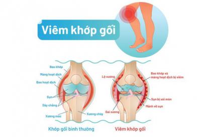 Bệnh viêm khớp gối là gì? Nguyên nhân và cách điều trị