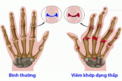 ĐIỀU TRỊ BỆNH VIÊM ĐA KHỚP DẠNG THẤP TẬN GỐC