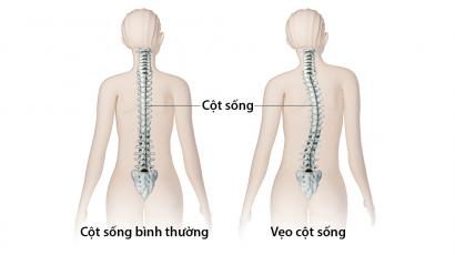 Những Cách Chữa Cong Vẹo Cột Sống Hiệu Quả