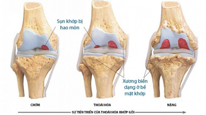 CHỮA BỆNH THOÁI HÓA CỘT SỐNG LƯNG KHỎI LÂU DÀI