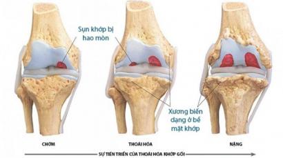 Điều trị dứt điểm thoái hóa khớp gối bằng kim siêu vi