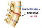 Điều trị bệnh gai cột sống thắt lưng. An toàn nhất HCM