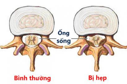 HẸP ỐNG SỐNG THẮT LƯNG GÂY NHIỀU BIẾN CHỨNG NGUY HIỂM