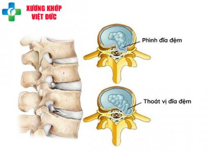 Bệnh lý phình đĩa đệm - Nguyên nhân, dấu hiệu và cách điều trị